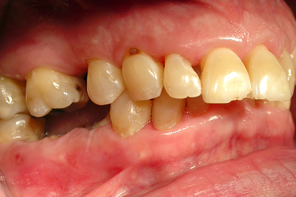 Multiple Implants Before