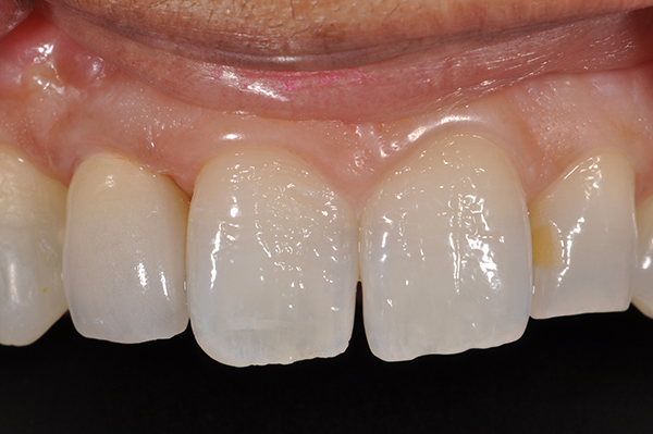 Single Implant Mill Hill After