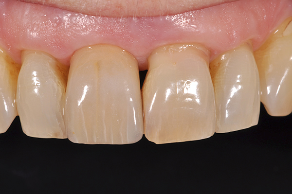 Single Implant Mill Hill, Nort London After