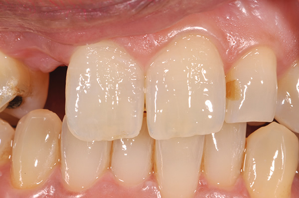 Single Implant Mill Hill Before