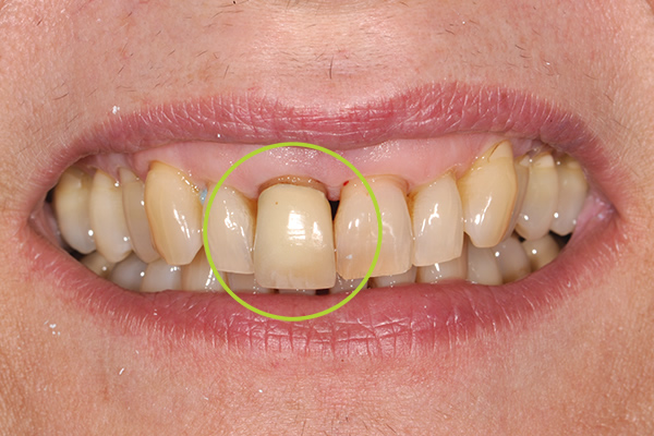 Single Implant Mill Hill East Before