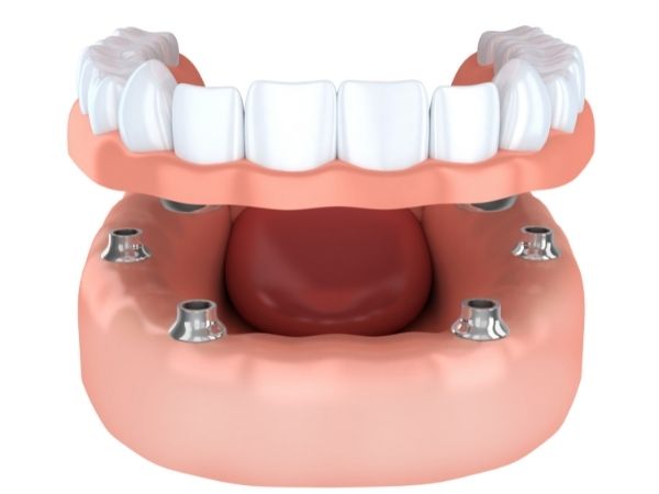 implant retained dentures mill hill